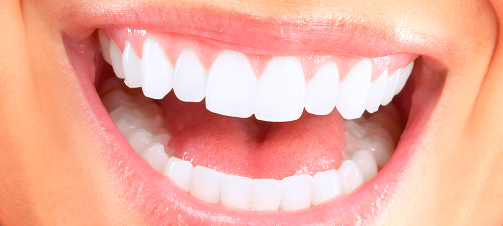 Estética dental: Blanqueamiento dental / Blanquejament dental - Carillas d