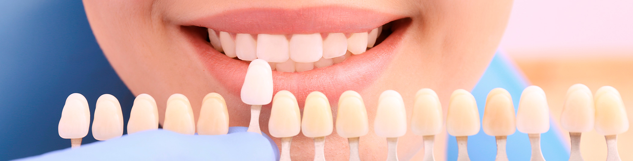 Selección de color para tratamiento de estética dental