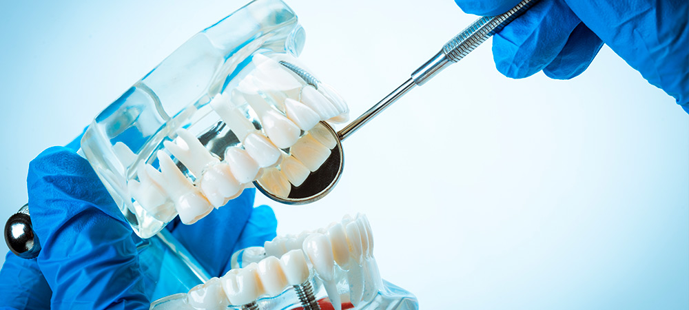 Implantació dental, implants dentals / implantación dental, implantes dentales