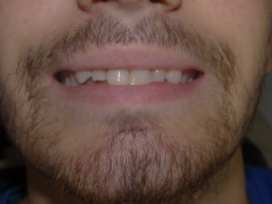 tractament invisalign