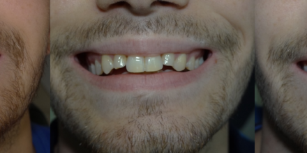 Cas Real: Invisalign i Estètica Dental