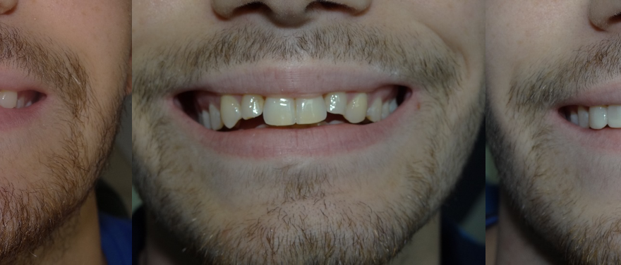 Cas Real: Invisalign i Estètica Dental