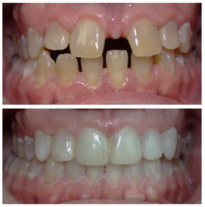 Caso real antes y después - Invisalign y Rehabilitación