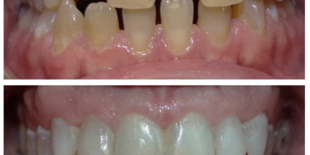 Cas Real: Invisalign i Rehabilitació