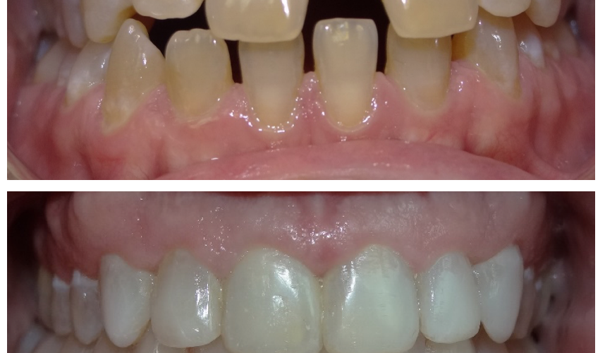 Caso Real: Invisalign y Rehabilitación